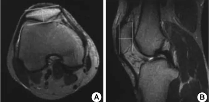 Fig. 1. Measurement of patellar thickness. (A) In the axial image, a temporary line was drawn connecting the medial and lateral ends of patella