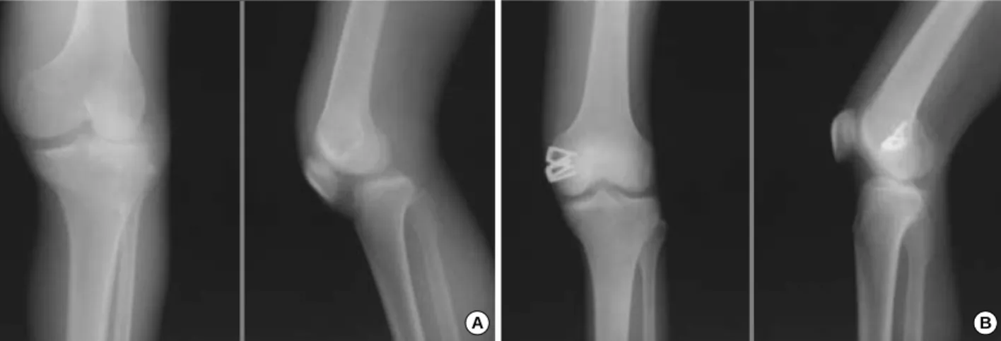 Fig. 1. A 21-year-old man with posterolateral dislocation of the left knee. We performed an open reduction and MCL repair in the first stage because there were reduction problems due to buttonholing of the medial femoral condyle through a torn capsule and 