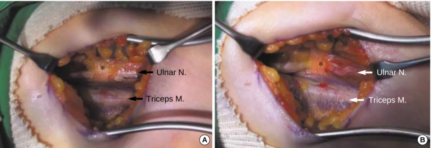 Fig. 1. Left elbow medial side. (A) Fibroligamentous structure (Struthers’ arcade, asterisk) originating from the triceps medial head to the medial intermuscular septum and is crossing the ulnar nerve