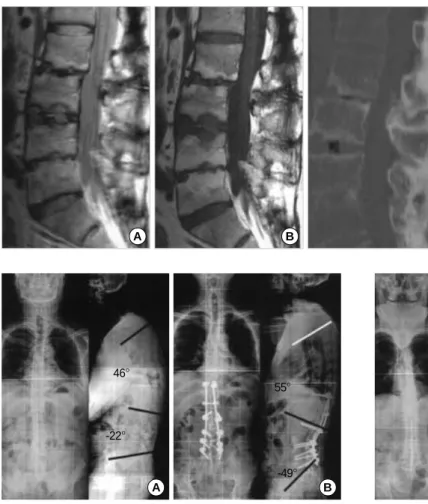 Fig. 5. (A) Anteroposteior and lateral preoperative radiograph of a 39-year-old man (case 9) with disabling mobile kyphotic deformity