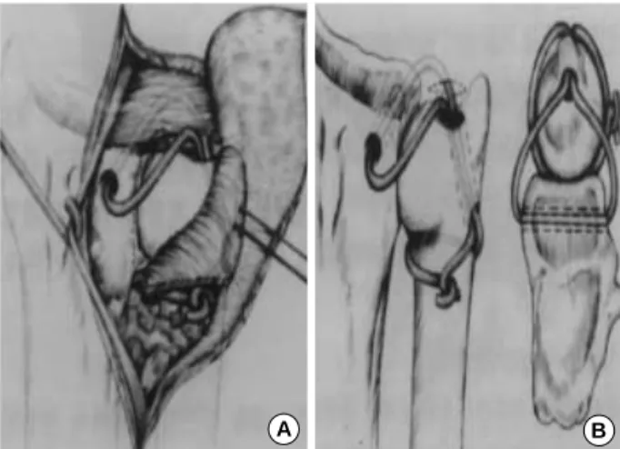 Fig. 3. (A) Malunion of the distal radius. (B) Open wedge osteotomy and an interpositional bone graft