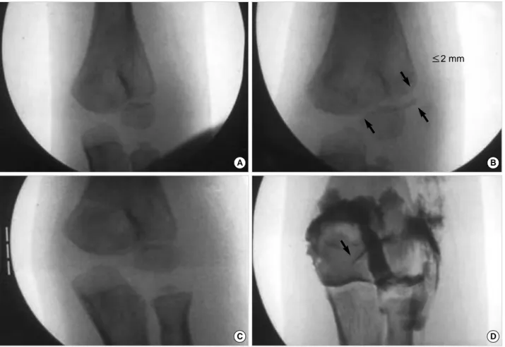 Fig. 1. A case of the Jakob stage Ib (Unstable). (A) Preoperative radiograph of a 4 year-old boy shows a fracture of the lateral condyle of the humerus