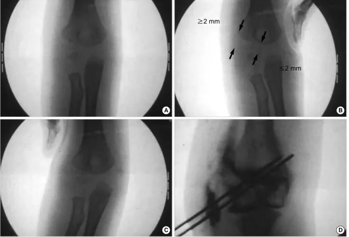 Fig. 2. A case of the Jakob stage IIa (Reducible). (A) Preoperative radiograph of a 20 month-old boy shows a fracture of the lateral condyle of the humerus