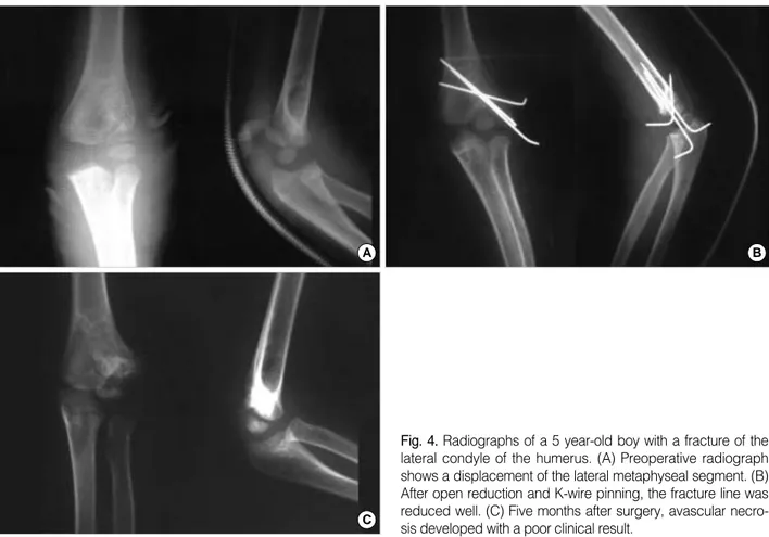 Fig. 3. Treatment algorism with a fine classification for patients with fractures of the lateral humeral condyle in children.