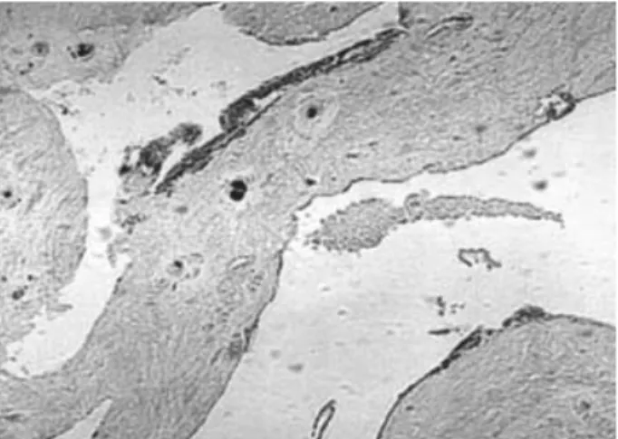 Fig. 1. Immunohistochemical staining for MMP-3 (counter-stain with H-E, ×100). Sparse expression of MMP-3 in HNP