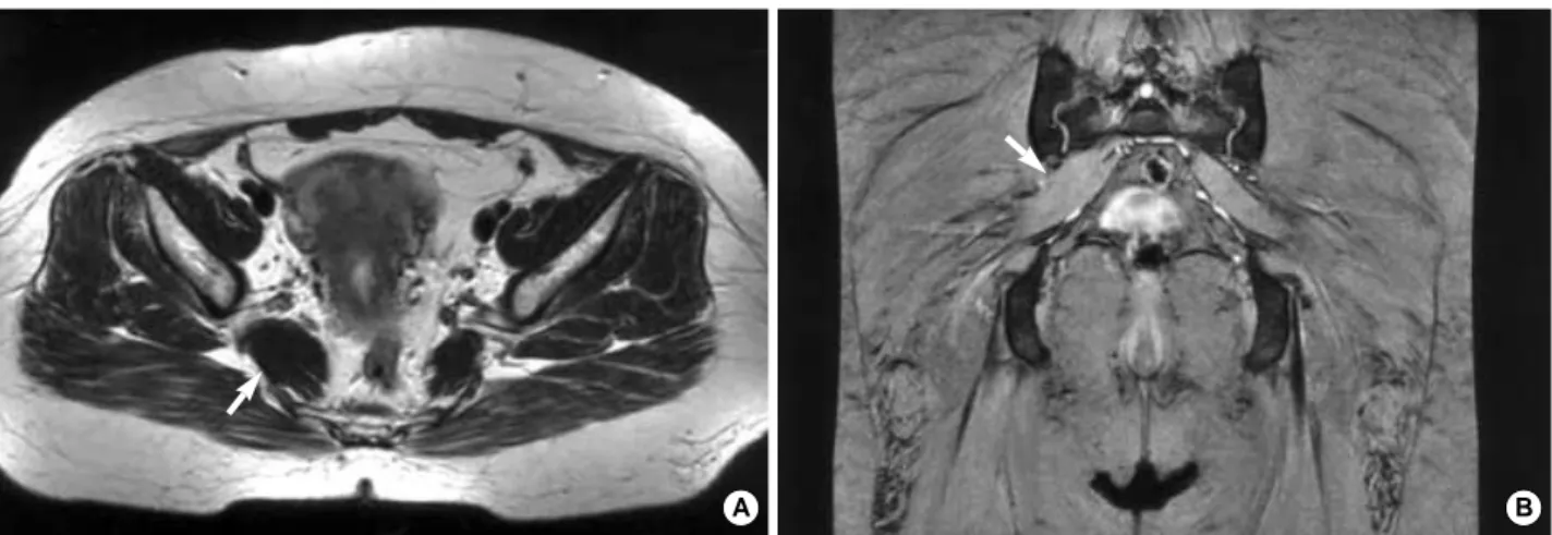 Fig. 1. Magnetic resonance image demonstrates the slightly hypertrophied right piriformis muscle (arrow) of the right hip