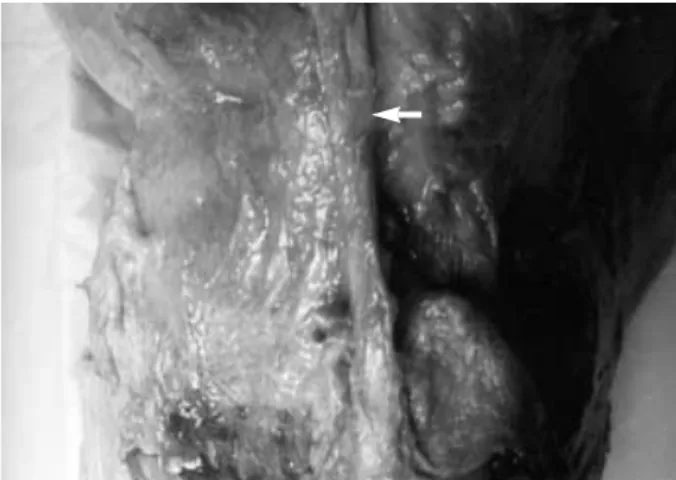 Fig. 2. Posterolateral corner of the knee. The arrowhead was lateral collateral ligament