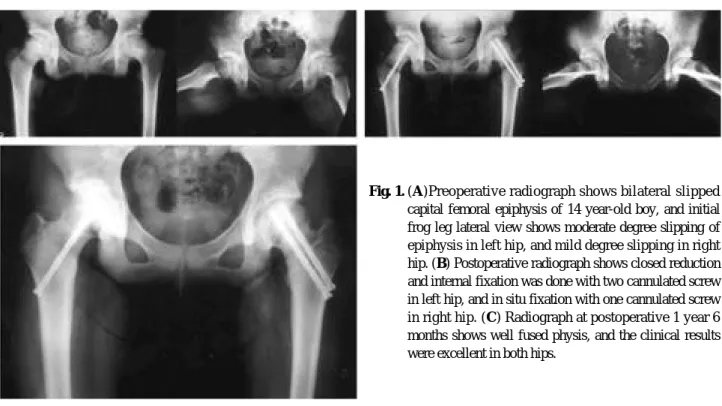 Table 1. Heyman and Herndon hip classification Excellent   No pain, no limp, normal range of motion