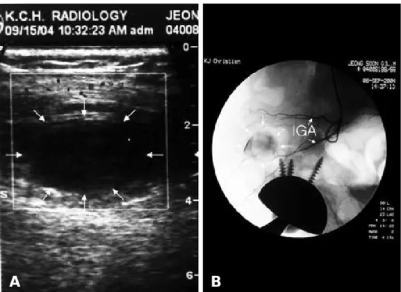 Fig. 2. At 4 months after intervention, the patient had vague pain in the area where white arrows outline.