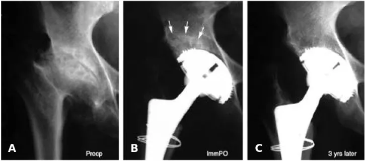 Fig. 1. The radiographs of a 50 year old male with Sequale DDH. (A) Preoperative AP view shows severe bone defect in superolateral aspect of acetabulum