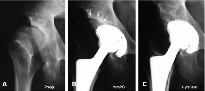 Fig. 2. The radiographs of a 28 year old male with Sequale DDH. (A) Preoperative AP view shows Crowe group III developmental dysplasia of the hip
