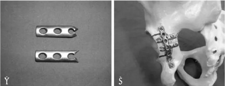 Fig. 1. A spring plate. (A) Closeup photograph of the spring plate. (B) A spring plate is fixed to acetabular model