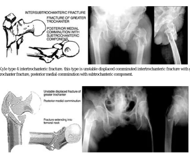 Fig. 1. Kyle type 4 intertrochanteric fracture. this type is unstable displaced comminuted intertrochanteric fracture with greater trochanter fracture, posterior medial comminution with subtrochanteric component.