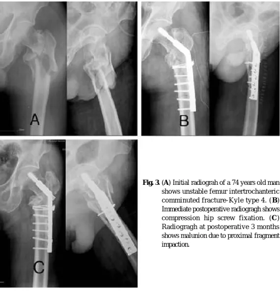 Fig. 3. (A) Initial radiograh of a 74 years old man shows unstable femur intertrochanteric comminuted fracture-Kyle type 4