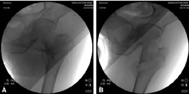 Fig. 1. (A) Varus configuration of fracture. (B) Valgus reduction after traction is a prerequisite for 2-neck screw fixation.