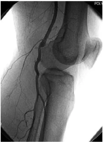 Fig. 4. Postoperative angiogram shows that the arterial lumen expands and is completely filled with contrast material