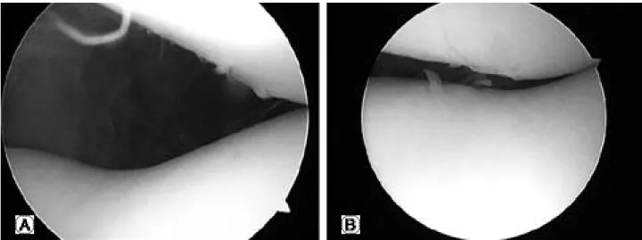Fig. 2. (A - B) After all arthroscopic lateral retinacular release, we performed four or five kont tying of medial capsule using #1-0 PDS.