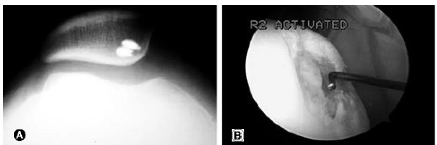 Fig. 4. (A) Reduction and internal fixation of disrupted osteochondral fracture fragment of medial facet of patella