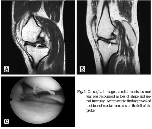 Fig. 1. On sagittal images, medial meniscus root tear was recognized as loss of shape and  sig-nal intensity