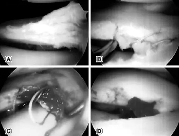 Fig. 1. (A) Horizontal tear of lateral meniscus. (B) Vertically sutured on horizontal tear with inside-out technique