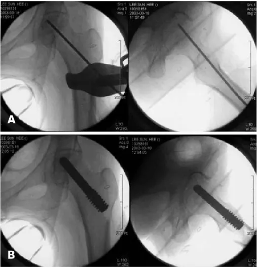 Fig. 2. (A) Guide pin was inserted in osteonecrosis site of the femoral head under C-arm guide