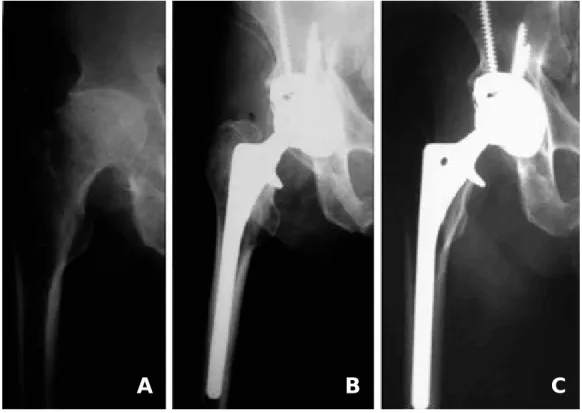 Fig. 4. Illustration showing the location and frequency of acetabular osteolysis according to DeLee and Charnley’s zone in the group 1(4-A) and the group 2(4-B).