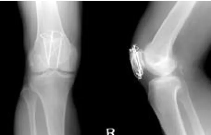 Fig. 3. Preoperative X-ray shows further migration of the wire into the posteroinferior space at the time of admission.
