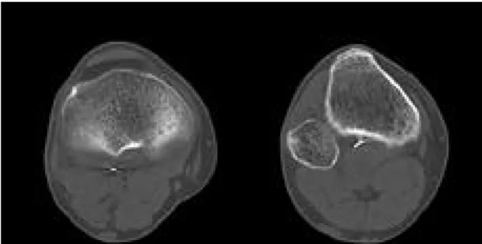 Fig. 5. 3D CT shows ultimate position of migrated wire frag- frag-ments behind proximal tibia and posterior capsule.