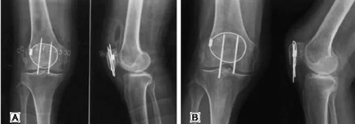 Fig. 3. (A) Post-Op. X-ray of 78 years old female for comminuted fracture of right patella (B) After 8 month after surgery patient vis- vis-ited for pain in inftapatellar area, and X-rays revealed complete union and migration of K-wires