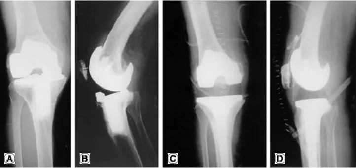 Fig. 1. Revision case for polyethylene insert wear (A, B ) Pre-operative radiographs showed polyethylene insert wear (C, D ) Post- Post-operative radiographs.