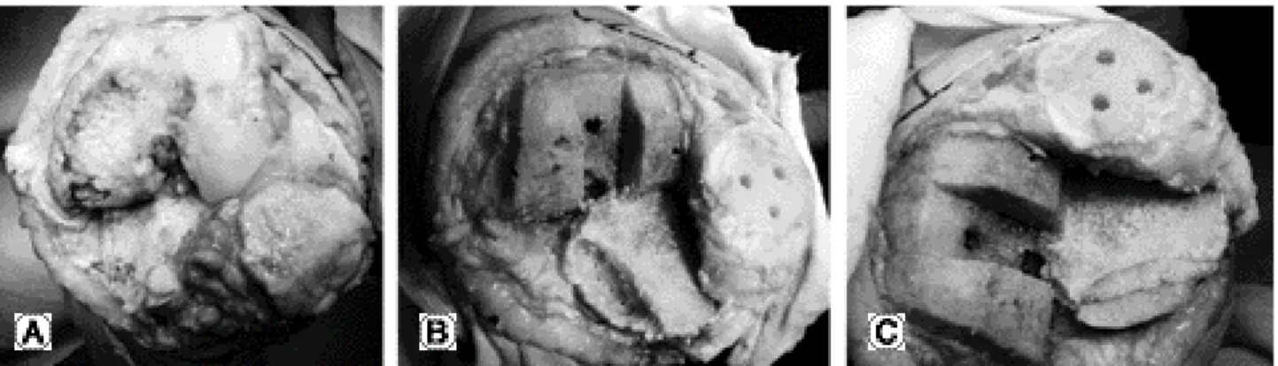 Fig. 1. Intraoperative photographs show (A) severe peripheral bone defect of the proximal medial tibia