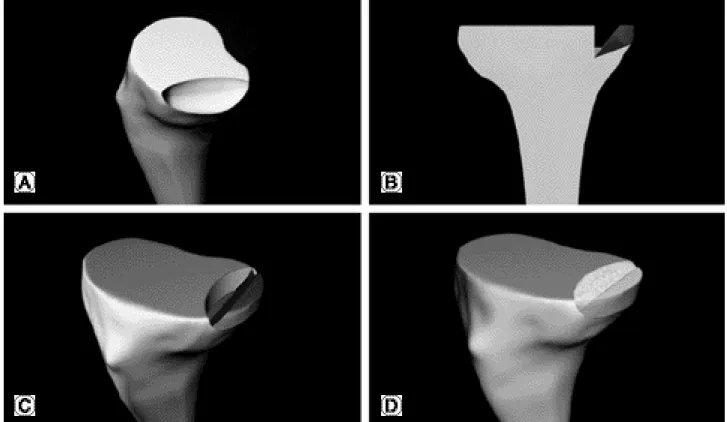 Fig. 2. Schematic illustrations represent the surgical technique of autogenous bone graft for (A) severe peripheral bone defect of the proximal medial tibia
