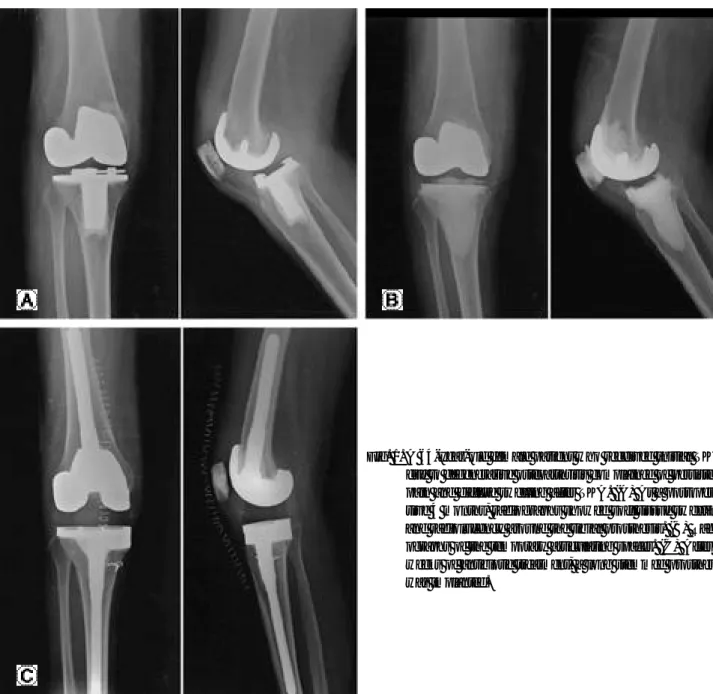 Fig. 1. A 64-year-old female patient who received initial TKA due to degenerative osteoarthritis complained of persistent pain and diffuse swelling after TKA