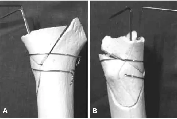 Fig. 1. After the reconstruction of proximal calcar region: (A) Anteroposterior view shows vertically oriented K-wires and circlage wires that fix the calcar fragment