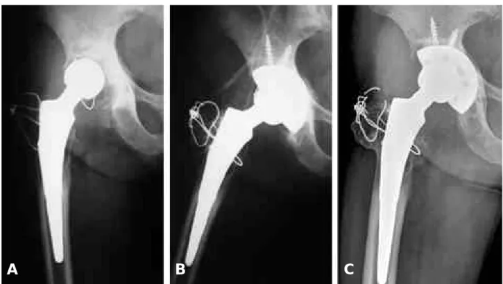 Fig. 1. (A) A radiograph shows excessive wear of polyethylene with well-fixed femoral stem at 9years 4months after primary total hip arthroplasty ( B) Only acetabular revision with use of uncemented cup was performed without exchange of femoral stem (C) Ra