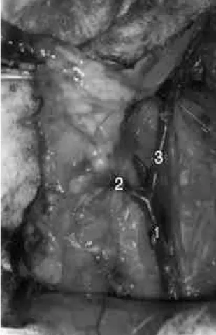 Fig. 1. Skin incision from lateral aspect.