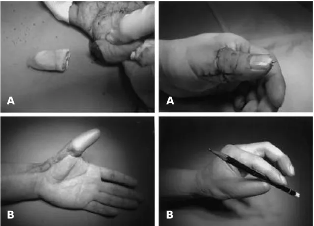 Fig. 1. (A) Preoperative photograph of a 40-year-old man with amputation of the left thumb