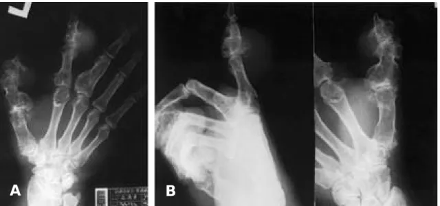 Fig. 1. (A) Photograph before surgery. There were a 3×2 cm sized firm oval mass on the dorsal aspect of middle pha- pha-lanx of the left index finger and 0.8×0.5 cm, 0.5×0.5 cm sized firm irregular masses on the multiple location of distal phalanx of the l