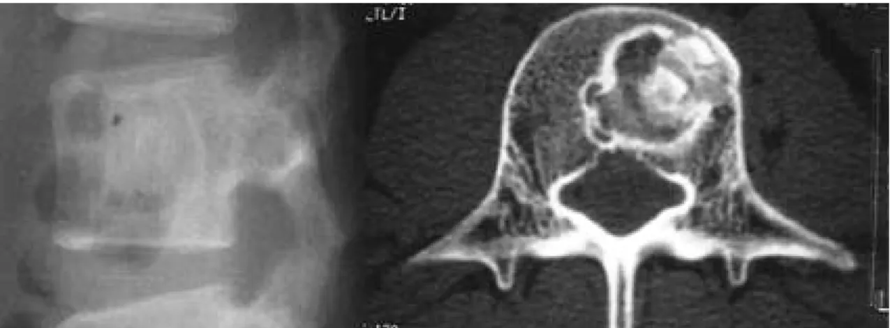 Fig. 4. Postop. 6 months radiography showing solid bone union.
