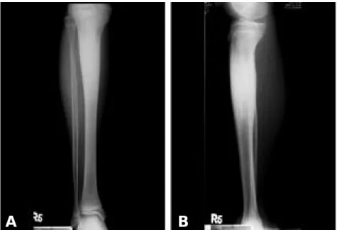 Fig. 1. AP (A) and lateral (B) plain radiographs of the right tibia showing extensive sclerosis and expansion