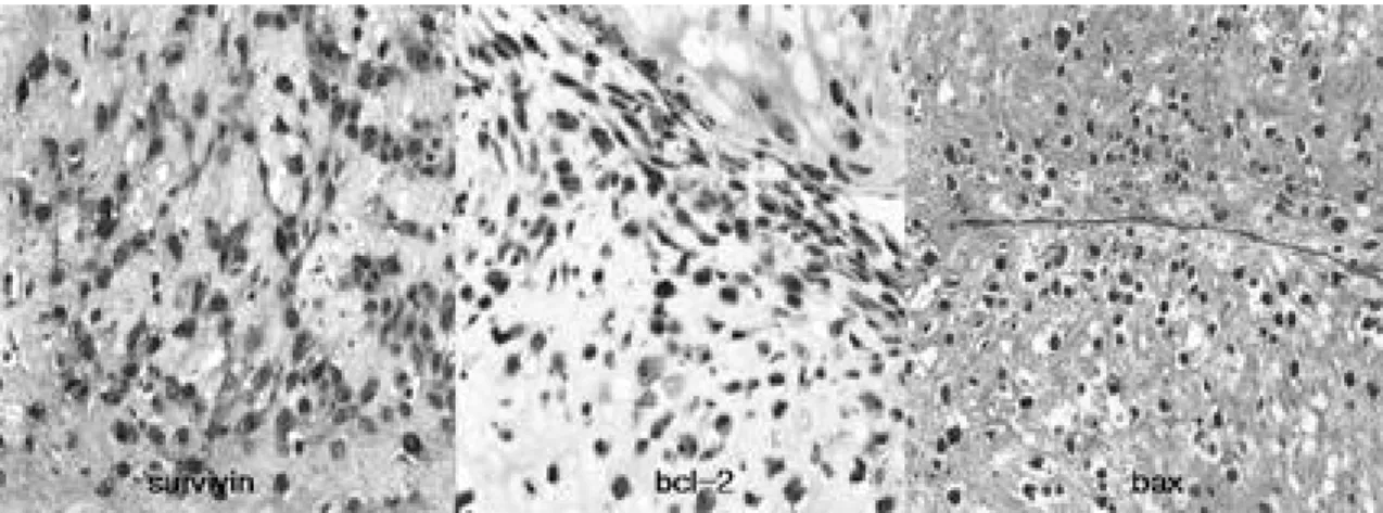 Fig. 1. Immunohistochemical staining of survivin, bcl-2 and bax shows an example of positive staining ( ×200)
