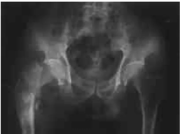 Fig. 1. 71 year-old-male. Lung cancer. Initial X-ray Osteolytic lesions are shown on subtrochanteric area of right femur with pathologic fracture.