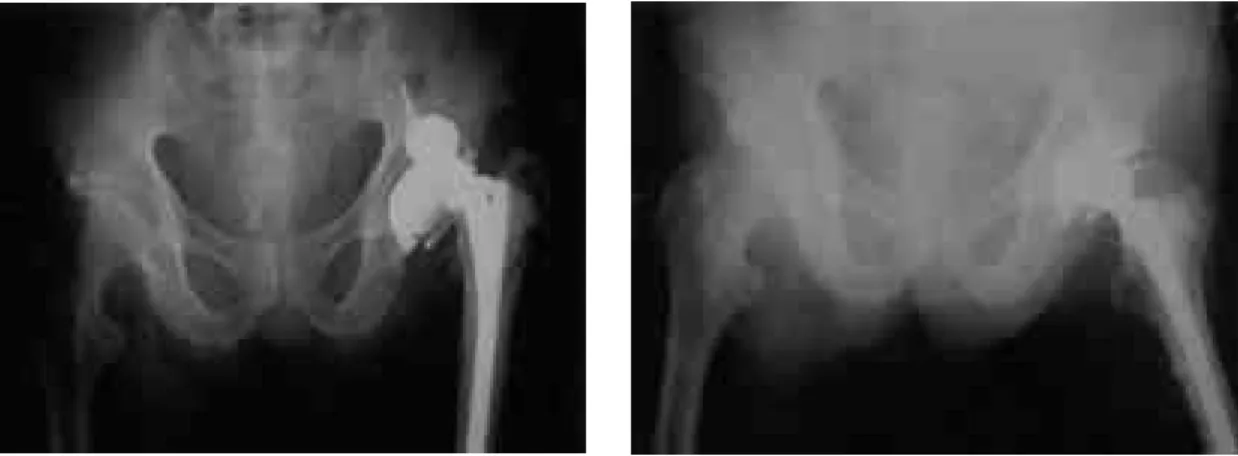 Fig. 15. 60 year-old-male. Lung cancer. Postoperative X-ray(Open reduction state)