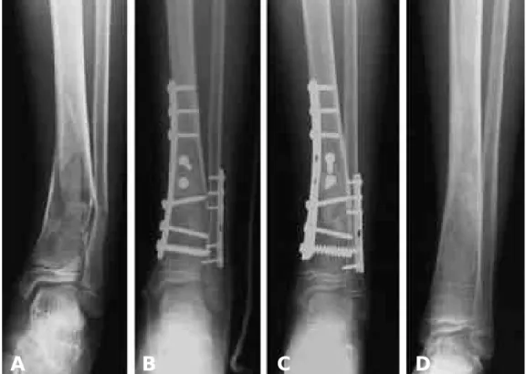 Fig. 2. Aneurysmal bone cyst with pathologic fracture of tibia in 15 years old boy. (A) Preoperative AP radiograph shows bone loss in tibia