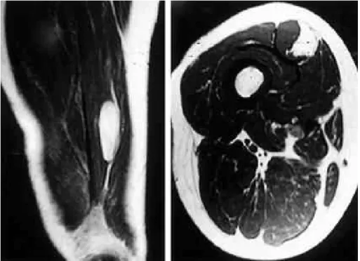 Fig. 1. 51 year-old female with palpable mass and pain on thigh for 1year. T1 weighted coronal and axial MRI show- show-ing high signal intensity mass and intramuscular mass
