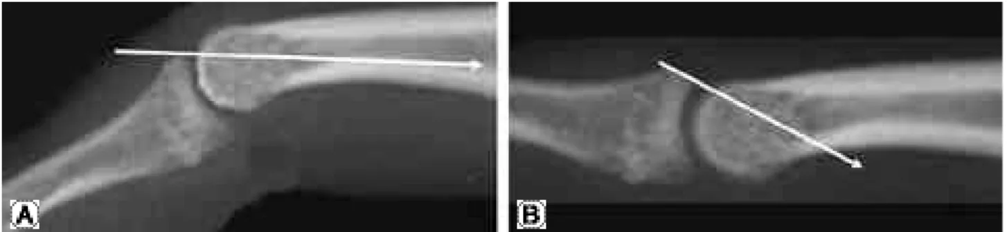 Fig. 5. The DIP joint was fixed at about 30 degrees flexion because the intramedullary K wire blocks extension of distal phalanx.