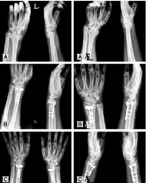 Fig. 1. (A) Posteroanterior (PA) and lateral radiographs of wrist in a 52 year old man (AO C2 type fracture); A-1 left wrsit, A-2 right wrist (B) Postoperative posteroanterior and lateral radiographs; B-1 left wrist, B-2 right wrist (C) Postoperative 9 mon