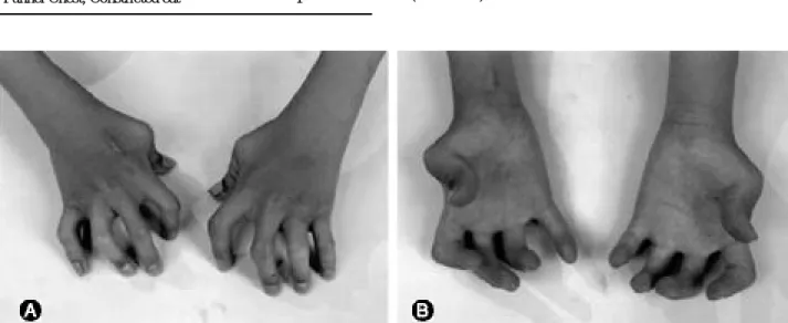 Fig. 1. Syndromic camptodactyly. Both hands and multiple fingers were involved. 