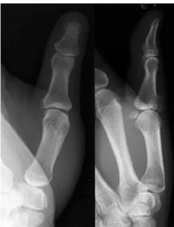 Fig. 1. A plain radiograph shows exostosis with calcification and mild cortical irregularity in the extensor aspect of base of proximal phalanx.