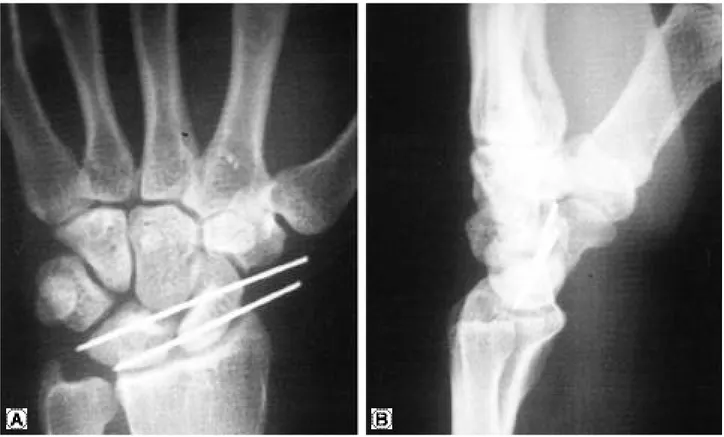 Fig. 3. Postoperative AP (A) and lateral (B) roentgeno-gram showing reduced lunate dislocation maintained with 2 K-wires.